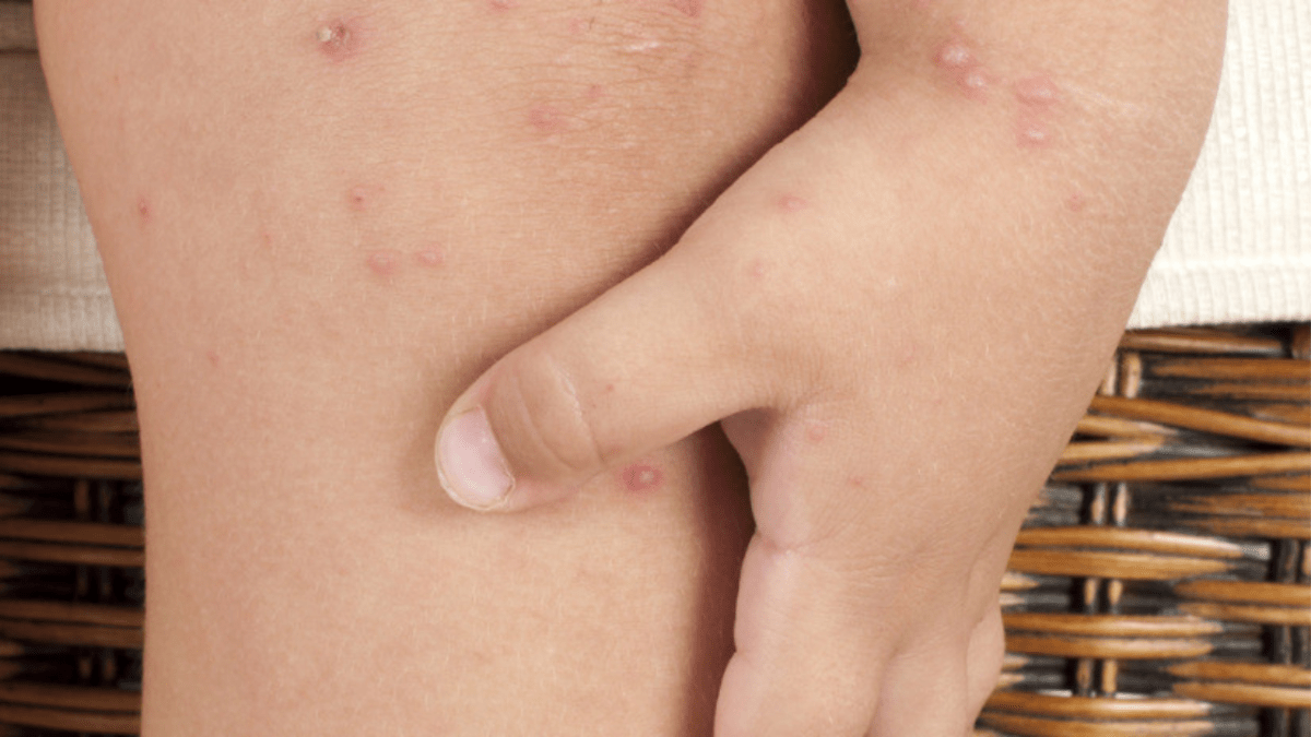 Foto: Especial | En los últimos días, la presencia del virus Coxsackie en bebés y niños ha causado temor entre los padres de familia.